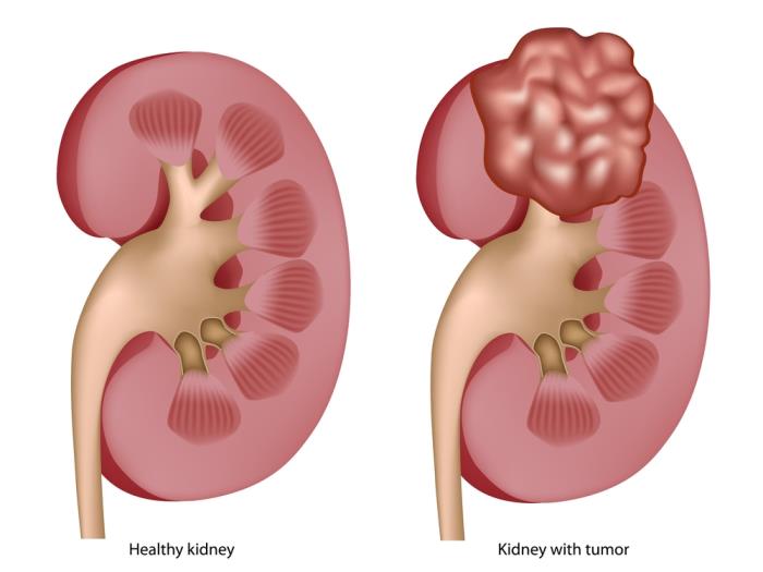 kidney cancer treatment in india