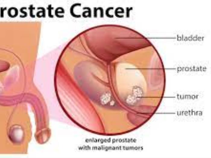 Prostate cancer treatment in india