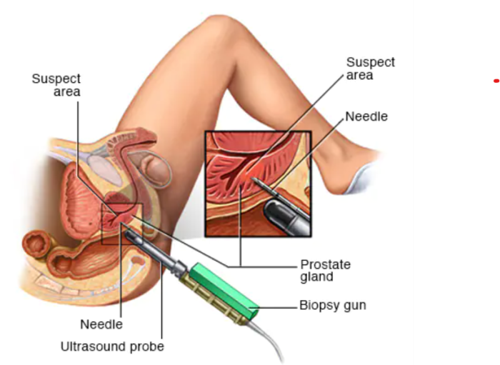 Metastatic Prostate cancer treatment in Mumbai India