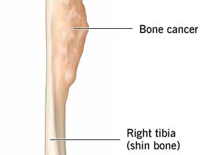 Bone Cancer Treatment in India