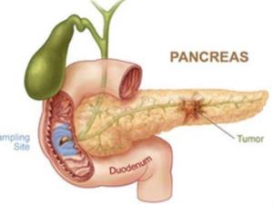 Pancreatic Cancer Treatment in India