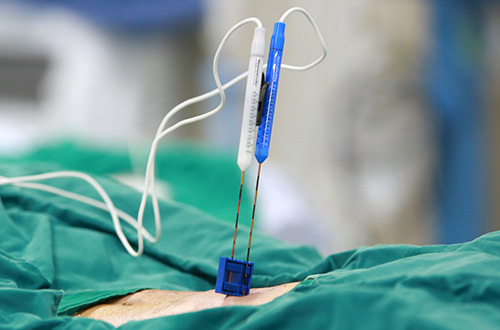Irreversible Electroporation for patients who don’t respond to radiotherapy and chemotherapy