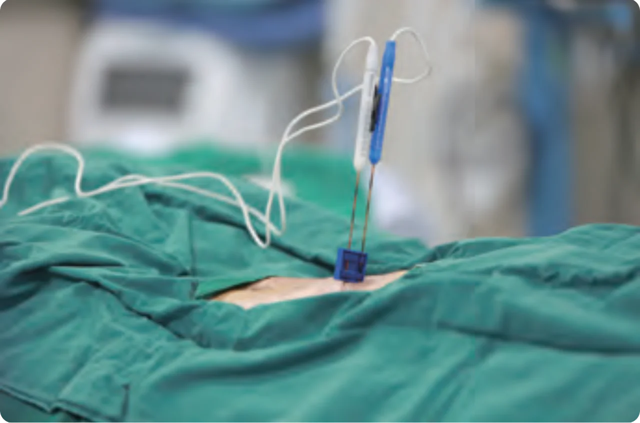 NanoKnife Ablation Procedure