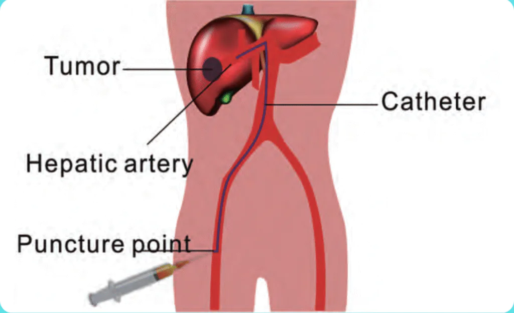 Transcatheter Tumor Vascular Intervention Procedure