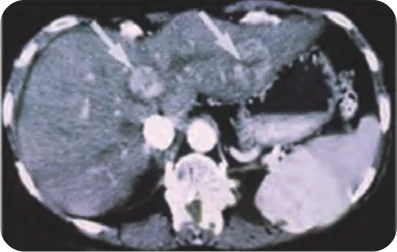 Alcohol Injection Therapy Procedure