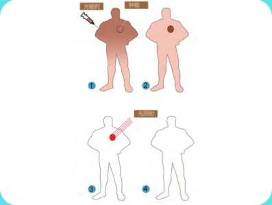 Photodynamic Therapy (PDT) Procedure