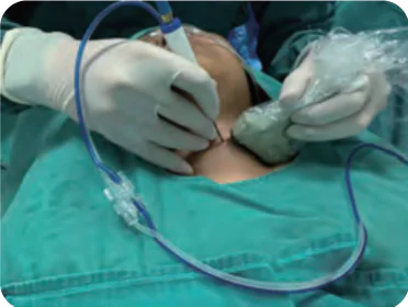 Microwave Ablation Procedure